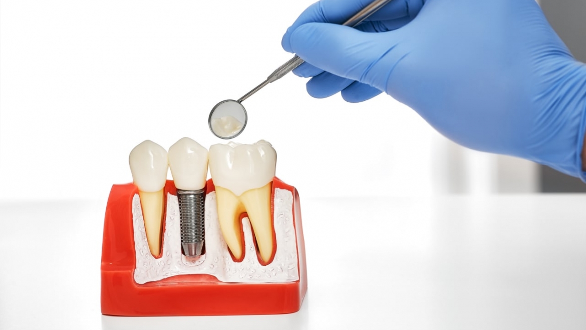 Resolvemos todas tus dudas sobre implantes dentales