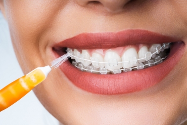 Cuidado esencial para tus brackets