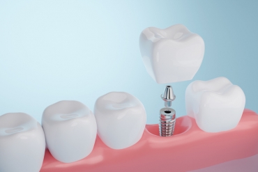 Guía esencial sobre implantes dentales