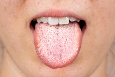Qué es la candidiasis oral en niños y adultos