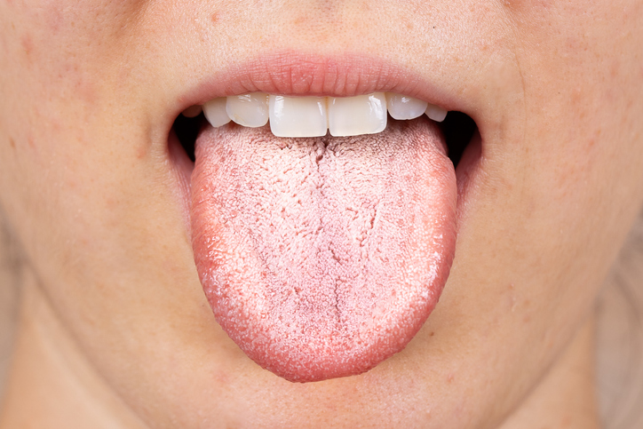 Qué es la candidiasis oral en niños y adultos