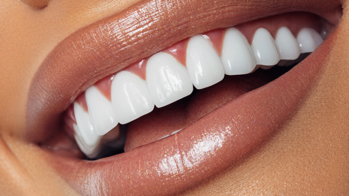 Cuidados y mantenimiento de las carillas dentales: consejos para una sonrisa duradera