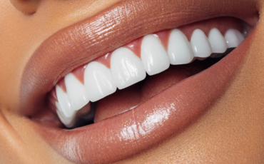Cuidados y mantenimiento de las carillas dentales: consejos para una sonrisa duradera