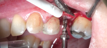Osteotomía dental: cuándo es necesaria y cómo se realiza