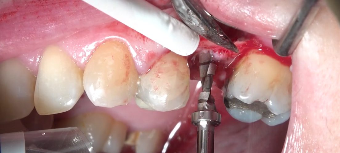 Osteotomía dental: cuándo es necesaria y cómo se realiza