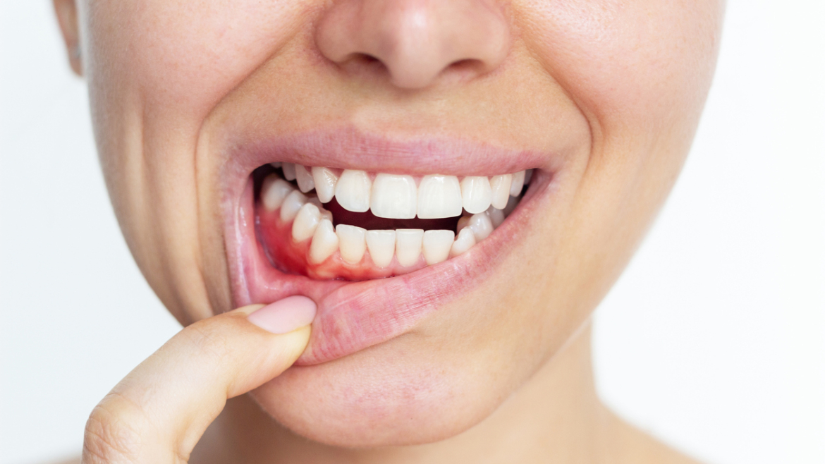 Gingivitis vs periodontitis: Diferencias clave que debes conocer