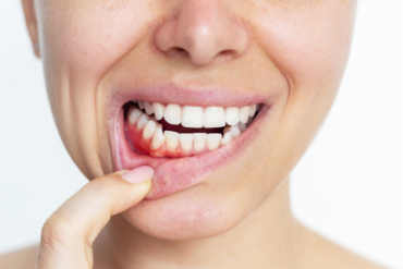 Gingivitis vs periodontitis: Diferencias clave que debes conocer