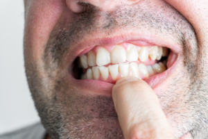 Opciones para tratar el desgaste dental