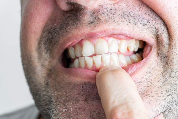 Opciones para tratar el desgaste dental y recuperar tu sonrisa