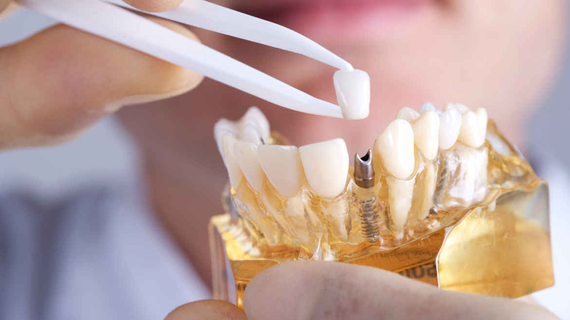 ¿Cuánto dura un implante dental? Factores clave