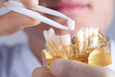 ¿Cuánto dura un implante dental? Factores clave