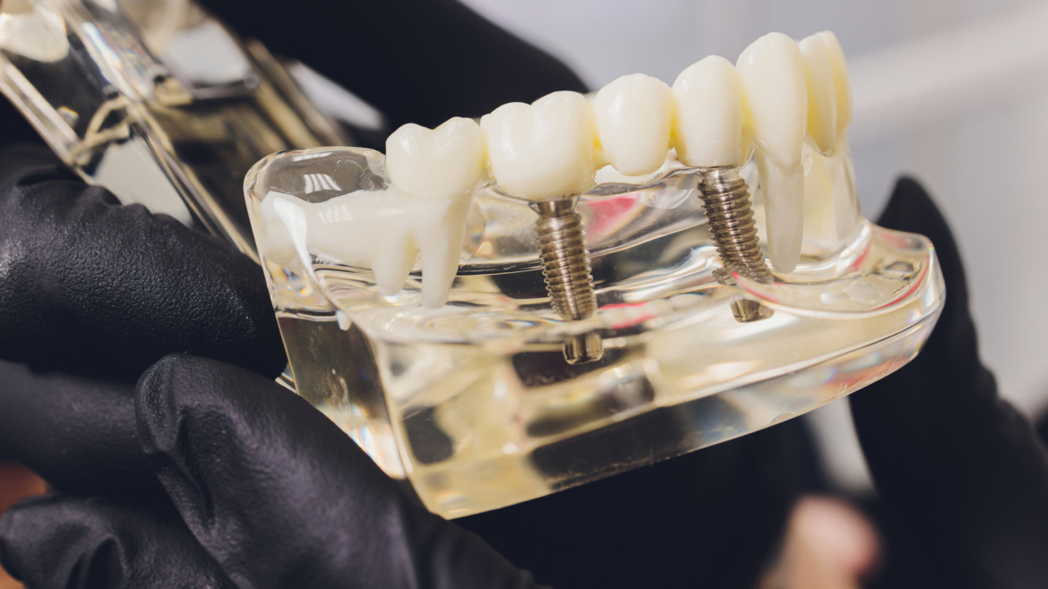 ¿El bruxismo afecta a los implantes dentales?