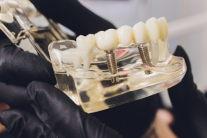 El bruxismo afecta a los implantes