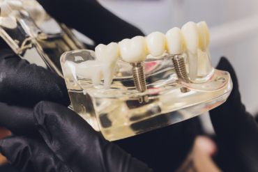 ¿El bruxismo afecta a los implantes dentales?