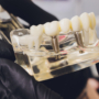¿El bruxismo afecta a los implantes dentales?
