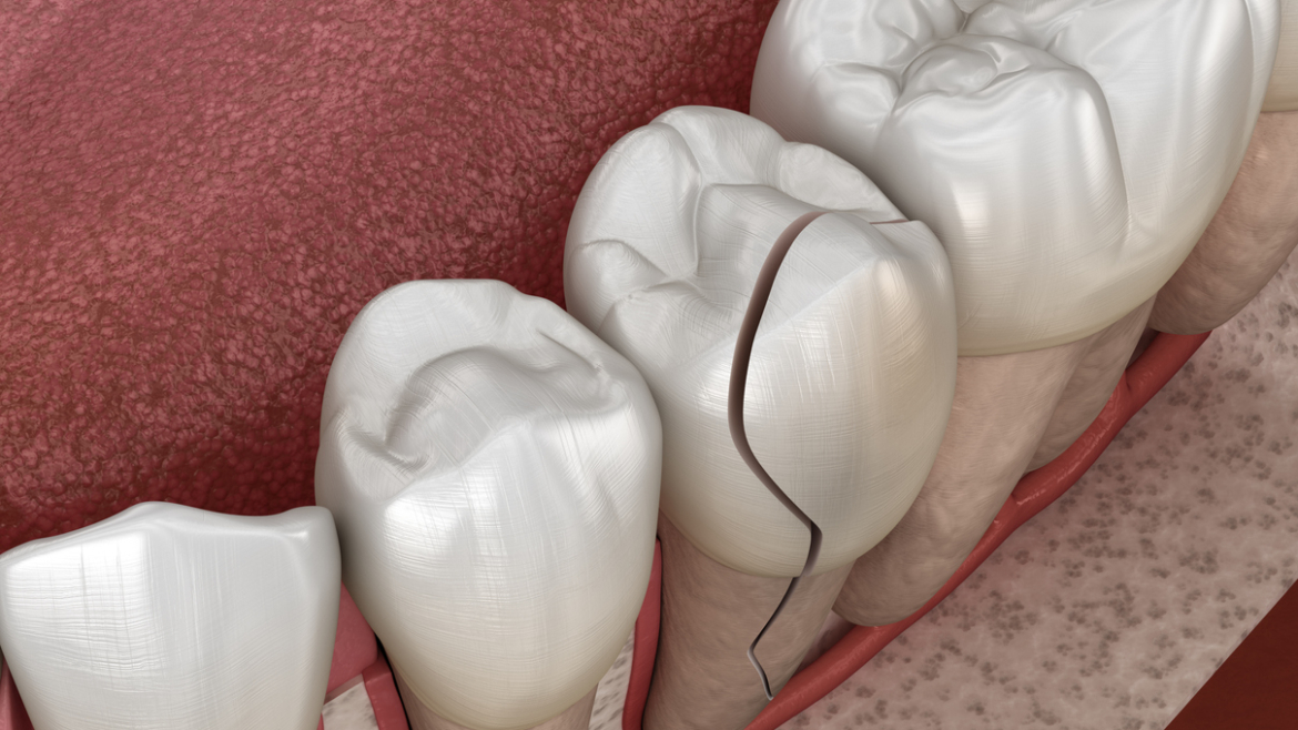 Síndrome del diente fisurado: El dolor invisible que pone en riesgo tu sonrisa
