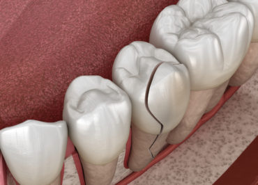 Síndrome del diente fisurado: El dolor invisible que pone en riesgo tu sonrisa
