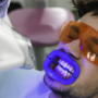 Manchas en los dientes: ¿el blanqueamiento dental puede eliminarlas?