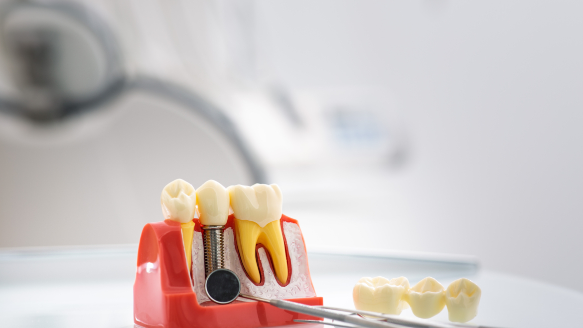 Implantes dentales en pacientes con antecedentes de enfermedad periodontal: cuidados a largo plazo