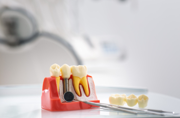 Implantes dentales en pacientes con antecedentes de enfermedad periodontal: cuidados a largo plazo