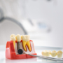 Implantes dentales en pacientes con antecedentes de enfermedad periodontal: cuidados a largo plazo